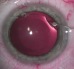 Chirurgie refractiva - lentile intraoculare Visian ICL