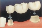 Coroane si lucrari dentare din ceramica in 8 zile!